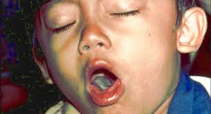 Whooping cough, or pertussis, is very contagious and mainly affects infants and young children. Three Confirmed Cases Of Pertussis Whooping Cough In Humboldt County Since Mid May Redheaded Blackbelt