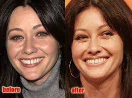 Shannen doherty is an american actress, producer, author, and director. Shannen Doherty Tired Of Plastic Surgery Geruchte
