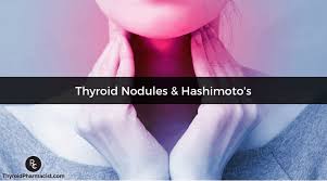 How to dissolve thyroid nodules naturally? How To Shrink Thyroid Nodules Dr Izabella Wentz