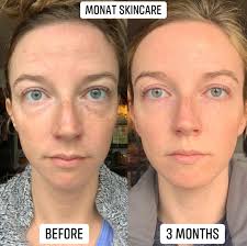 Wow!!! Check out her 1 year results with this skincare🤩 For the majority  of the time, this gal used the Expert Line, but now with the dry, cold  winter in Alberta, she's