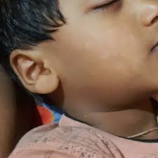 The infection tinea versicolor is caused by skin yeast known as pityrosporum ovale. Paediatrician Hii Sir My Son Is Now 7yrs Old He Is Getting White Spots On Face Plz Give Us Solution We Have Shown To All Pediatricians They Said There Is No Pblm