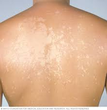 The condition does not leave any. Tinea Versicolor Symptoms And Causes Mayo Clinic