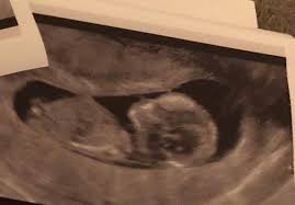Ultraschallbild 14 Ssw Erkennt Man Bereits Das Geschlecht Schwangerschaft Frauenarzt