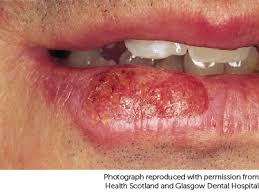 Image result for Lip Cancer