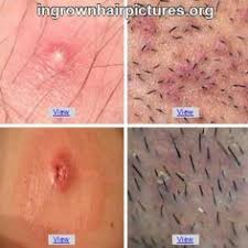 Herpes or ingrown hair? isn't a fun game to play, but no matter what you're experiencing, there's no need to panic. Shawn Liddle Shawnliddle Profile Pinterest