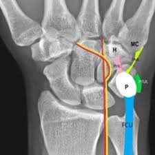 Image result for Pisiform Bone