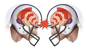 Перевод слова concussion, американское и британское произношение, транскрипция, словосочетания, однокоренные слова, примеры использования. Do Helmets Protect Against Concussion Queensland Brain Institute University Of Queensland