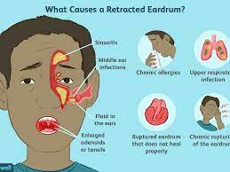Retracted Ear Drum Causes Symptoms And Treatment