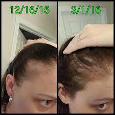 A Team Member On December 18 2015 She Was Diagnosed With Lichen Planopilaris An Autoimmune Disease That Att Help Hair Loss Hair Treatment Hair Growth Formula