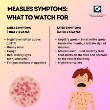 Image result for measles