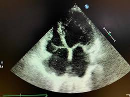 Man unterscheidet akute von chronischen formen der herzmuskelentzündung, wobei die akute myokarditis in eine chronische übergehen kann. Cureus A Case Of Hemolytic Anemia With Acute Myocarditis And Cardiogenic Shock A Rare Presentation Of Covid 19