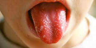 Granos En La Lengua En Bebes Y Ninos Tratamiento