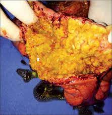 Colitis Pseudomembranosa Tras Abdominoplastia Circunferencial Postbariatrica Caso Clinico