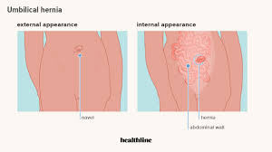 They help in moving our neck flexibly and protect the pharynx and tonsils area. Hernia Pictures Of 6 Common Types