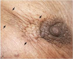 Learn the signs and symptoms of breast cancer and talk to your doctor immediately if you experience any of these signs. Evaluation And Imaging Features Of Malignant Breast Masses Radiology Key