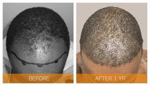 What causes hair loss for black people? Hair Transplants For African Americans Nashville Hair Doctor