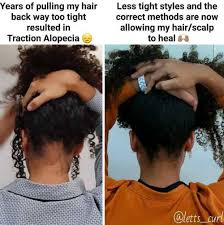 Natural oils when growing your edges, it is wrong to use creams or greasy products as this will not penetrate your scalp. 4 Causes Of Edges Hair Loss And How To Regrow Them Fast