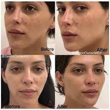 😇 Tratamiento: Contorno de mandíbula sin cirugía 🎯 Propósito: Mejorar la  mandíbula 👓 Cómo funciona: el uso de inyecciones NEUSTEMTM 🎉 Results:  Immediate Nota: Los resultados individuales pueden variar 📞 Phone: +1 (