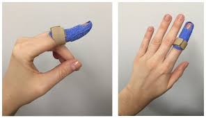 They may represent an isolated tendinous injury or occur i. Splinting With Orficast Thermoplastic Tape Orficast Alternatives To Thermoplastic Splints Of The Hand And Finger Made B Splint For Finger Hand Therapy Finger