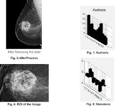 For many types of cancer in dogs and cats, it is common for routine blood tests such as the complete blood count and chemistry panel to be completely normal. Pdf Breast Cancer Detection Using Image Processing Techniques Semantic Scholar