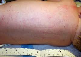 Both affect the mucous membranes and skin. Petechiae In A Newborn Photo Quiz American Family Physician