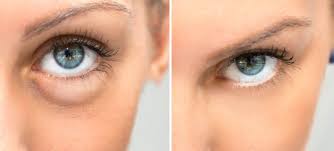 Break out the big guns! Bags Under Eyes Symptoms And How To Get Rid Of
