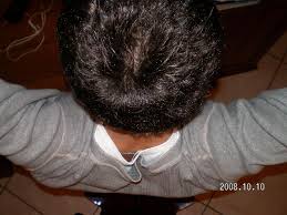 Ai margini di queste aree, i capelli sono corti e spezzati. 17 Anni Caduta Capelli Aiuto Chiedi All Esperto Salusmaster