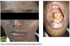 Image result for cancer of tongue