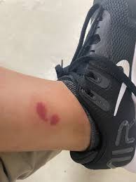 釣りの際は虫に注意！ブヨに刺されるとヤバいです！ | フィッシング遊