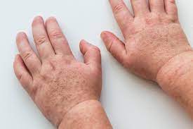 Jun 04, 2021 · i vantaggi. Scarlattina Come Evitare Il Contagio Da Adulti Pazienti It