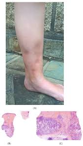 Image result for Panniculitis