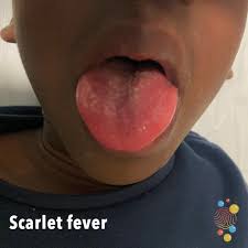 Image result for Scarlet Fever