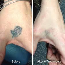 Results for tattoo removal are variable and dependent on factors such as: Patient 5 Laser Tattoo Removal Chao Plastic Surgery