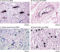 심근염 자연 발생율의 1/10에 불과합니다. Myocarditis And Inflammatory Cardiomyopathy Current Evidence And Future Directions Nature Reviews Cardiology