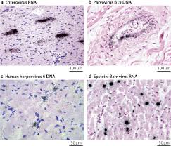 Myocarditis is clinically and pathologically defined as inflammation of the myocardium in the absence of the predominant acute or chronic ischaemia characteristic of coronary artery disease. Myocarditis And Inflammatory Cardiomyopathy Current Evidence And Future Directions Nature Reviews Cardiology