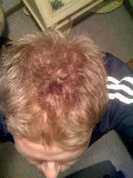 Even thin hair will appear terrific with these absolutely marvelous long hairstyles specially designed for thin hair. Whats Going On Hairlosstalk Forums