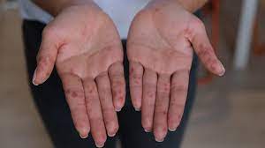 Although your child is most contagious with. Hand Foot And Mouth Disease In Adults Symptoms And Treatment