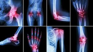 Image result for a well hydrated and dehydrated joint - comparison
