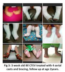 However, in these cases, the foot is usually more deformed. Clubfoot Congenital Talipes Equinovarus Narayana Health