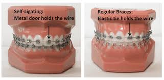 See a free 3d preview of your new smile and order your clear aligners. Damon Braces The Latest In Orthodontics