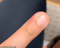Maybe you would like to learn more about one of these? 18 Year Old Nearly Had Her Finger Amputated After Nail Biting Infection Daily Mail Online