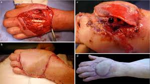These include spoiled bread, fruit, and vegetables, as well as soil and compost piles. Mucormycosis Infection In The Upper Limb A Salvageable Condition Journal Of Hospital Infection