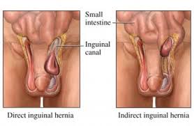 Penyakit angin pasang (inguinal hernia) kita kerap mendengar kes kes angin pasang berlaku pada orang dewasa dan kanak kanak. Angin Pasang Uluran Hernia Urut Bersalin Tradisional Malaysia