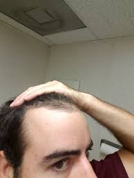 Having lost hair due to stress over the pandemic, both erica (left) and aggie added hair extensions and color to revive. I Am A 21 Year Old Looking For Advise On How To Approach Receding Hairline Photo