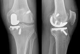 Image result for Knee XRay