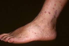 Read about symptoms, diagnosis, home remedies scabies is a skin condition that causes severe itching. Jock Itch Netherlands Pdf Ppt Case Reports Symptoms Treatment