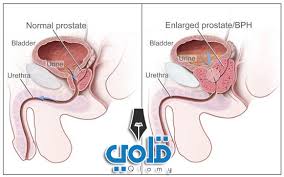 لكن هذا المرض في الطب الشعبي، له تعريف بسيط ولذلك له علاج أيضا وحتی يمكن القول بأن علاج التصلب المتعدد بسيط جدا. Ø¹Ù„Ø§Ø¬ Ø§Ù„ØªÙ‡Ø§Ø¨ Ø§Ù„Ø¬Ù‡Ø§Ø² Ø§Ù„ØªÙ†Ø§Ø³Ù„ÙŠ Ù„Ù„Ø±Ø¬Ù„ Ø¨Ø§Ù„Ø§Ø¹Ø´Ø§Ø¨ Ù‚Ù„Ù…ÙŠ