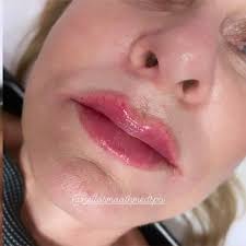 Hello Smooth What Is The Botox Dysport Lip Flip As The