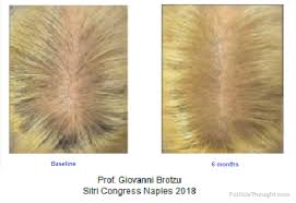 Experiencing hair loss or just want faster hair growth? Updates Cures For Hair Loss 2021 Follicle Thought