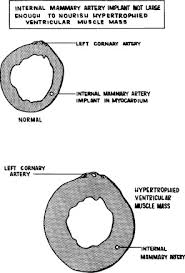 We did not find results for: The Surgical Treatment Of Coronary Artery Heart Disease By Internal Mammary Artery Implantation Report Of 140 Cases Followed Up To Thirteen Years Sciencedirect